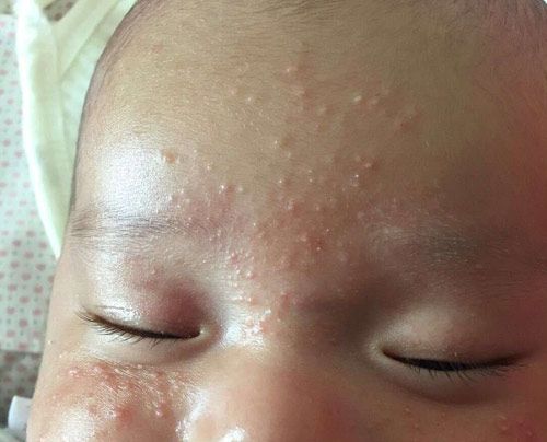 宝妈容易长痱子,宝妈长痱子