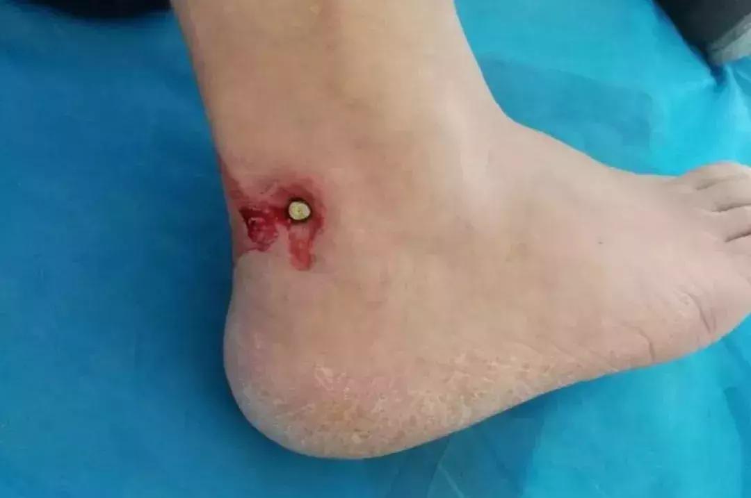 射钉枪打到手很痛怎么办,用射钉枪打钢钉