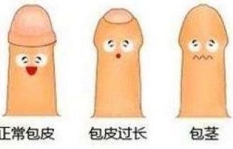 男生要不要割包皮,包皮到底要不要割了