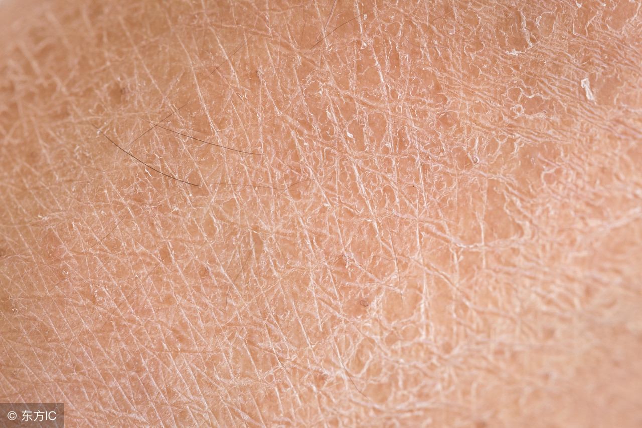 鱼鳞病能吃各类调料吗,鱼鳞病可以吃发物吗