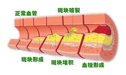 降胆固醇，抗血小板——冠心病的基础治疗