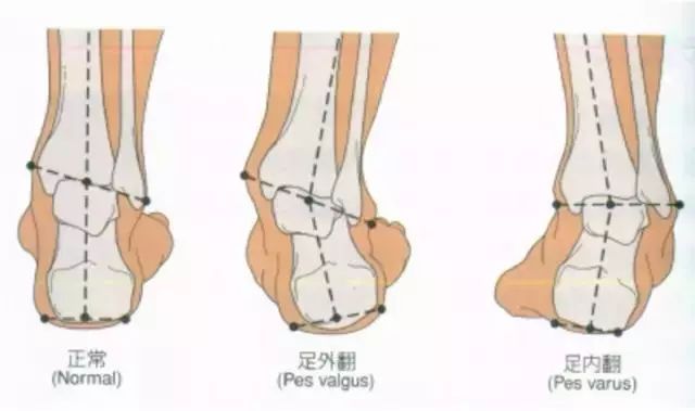 崴脚后怎么恢复训练,崴脚伤到筋怎么恢复