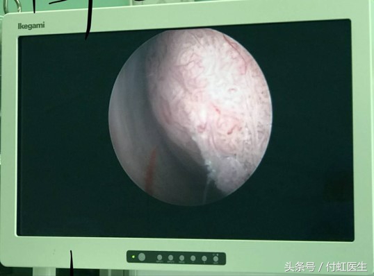 子宫内膜厚水样白带,子宫内膜厚内膜息肉白带水样