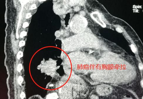头晕、手麻，不是脑血栓，是肺癌脑转移？豪大夫讲肺结节（三）