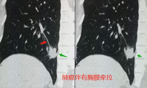 头晕、手麻，不是脑血栓，是肺癌脑转移？豪大夫讲肺结节（三）