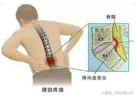 腰间盘膨出贴什么膏最好,腰间盘膨出可以做深蹲吗