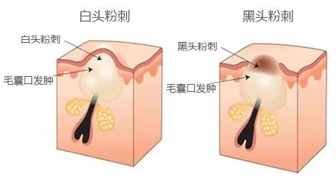 去黑头神器网红同款,去黑头神器高档