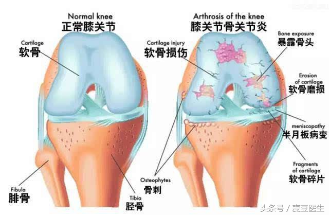 长骨刺还有救吗,骨刺是保守治疗还是手术治疗