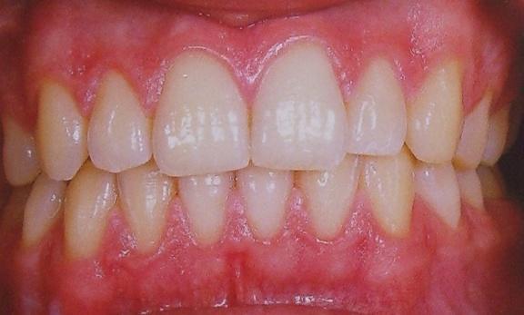 怀孕3个月胎瘤能生下来吗,怀孕30周牙龈瘤非常严重怎么办