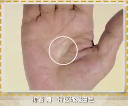 手是健康的镜子,手的健康识别