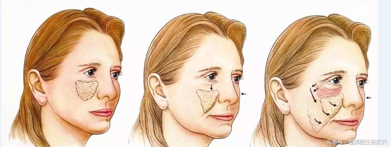 脸部肌肉下垂怎样变得紧致医美,脸部肌肉下垂怎么办