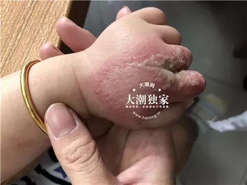 隐翅虫咬人症状图片,隐翅虫咬人症状最初图片