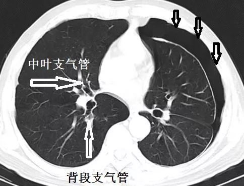 这样的气胸不少见,胸腔穿刺需谨慎!