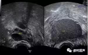 卵巢畸胎瘤的超声声像诊断,超声能不能看到卵巢畸胎瘤内部