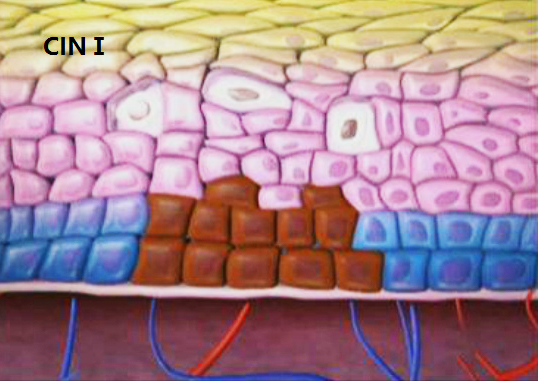 宫颈癌早期要不要紧,宫颈癌前病变不要焦虑