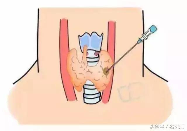 如何从脖子外面看出甲状腺结节,甲状腺结节从脖子上可以看出来吗