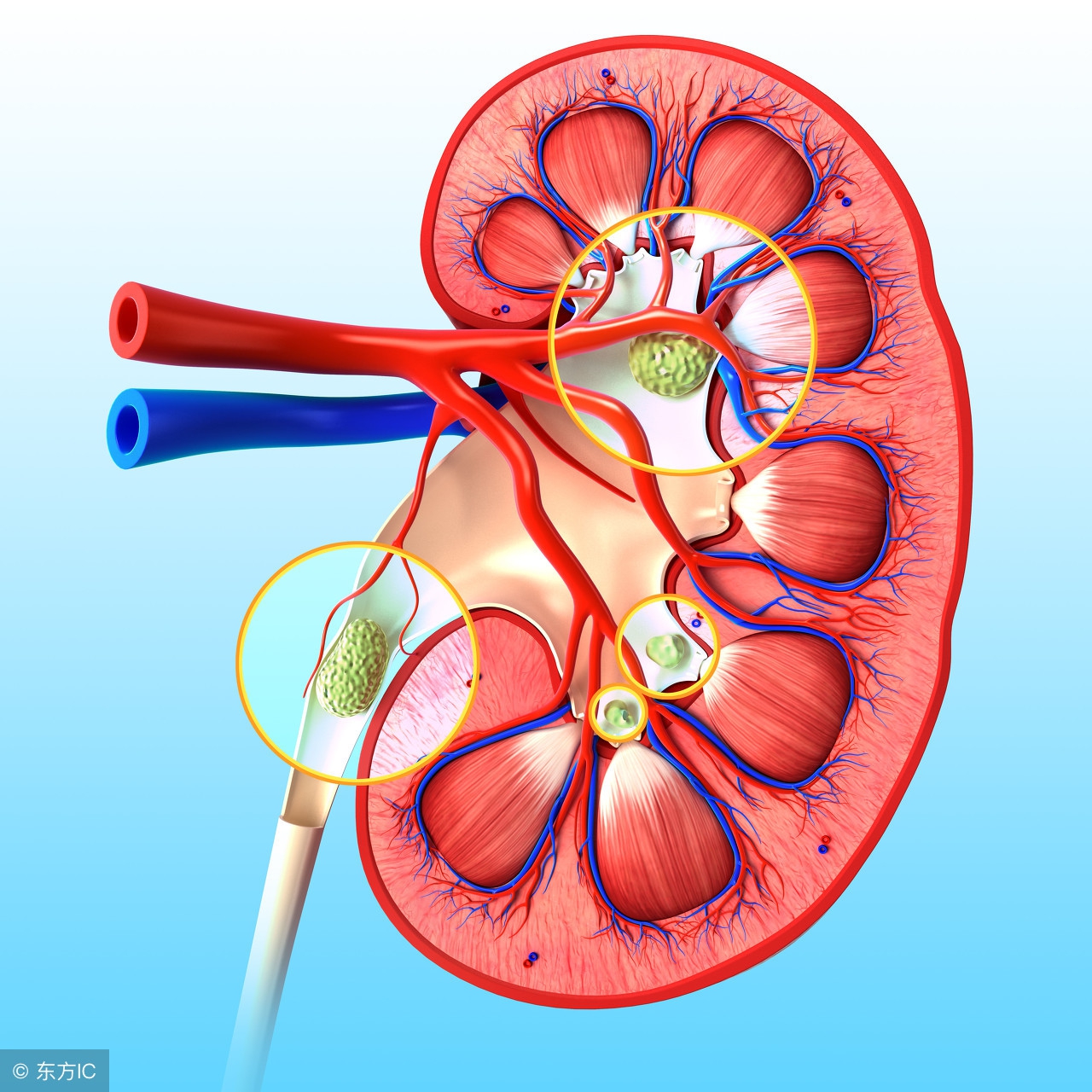 患有肾结石一定要注意这5点,肾结石危害表述不准确