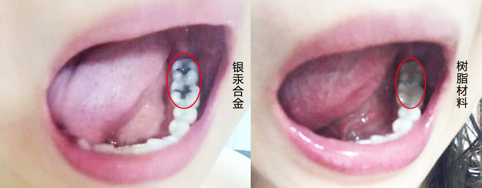 银汞合金——口腔界的“诺基亚”