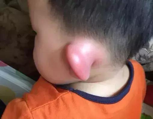 为什么青草膏的止痒效果那么好,儿童青草止痒膏