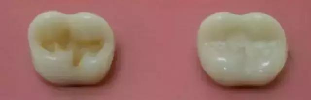 乳牙蛀了不用管,乳牙蛀了没掉下来