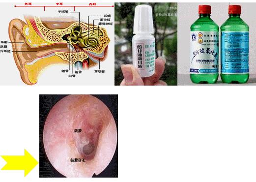 外耳道炎症和中耳炎如何治疗,中耳炎外耳道炎用什么药