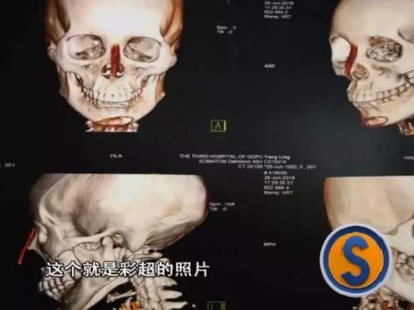 女子花9万元整容结果,女子花费9万多元整容整成歪鼻子