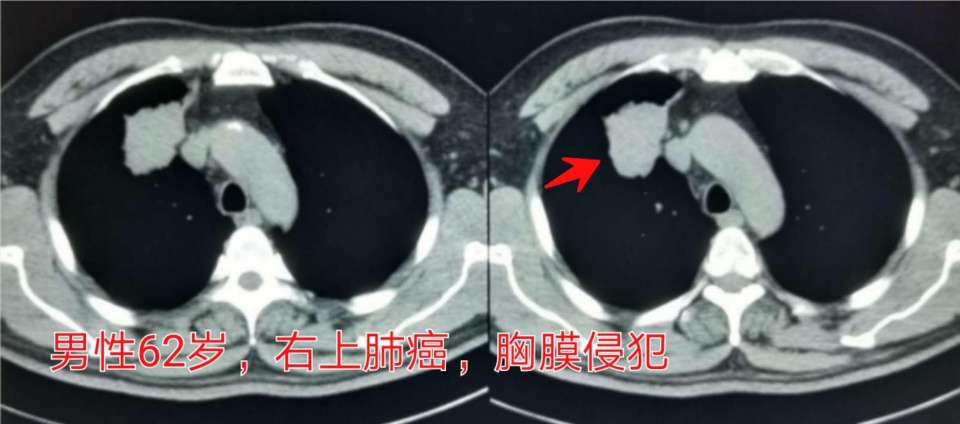 治疗癌症的靶向药能不能停,靶向治疗药物任何癌症都可以吃吗