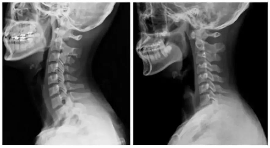 颈动脉狭窄应注意哪些,颈髓受压要注意什么