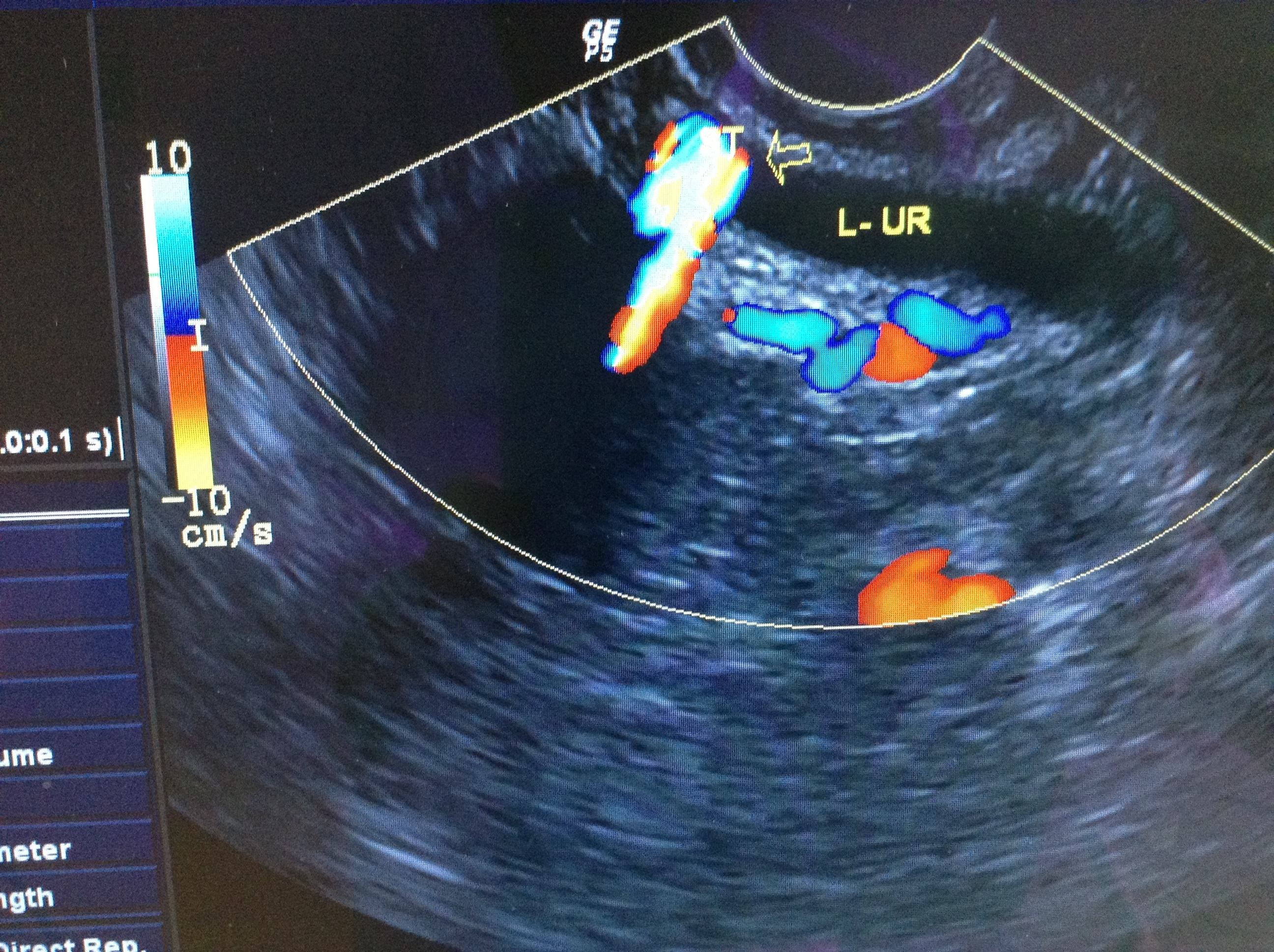 第一次做阴超是什么体验？不但没有想象中那么疼，还有一个优点