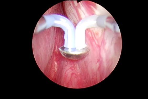 打破国际“金标准”他用“一粒纽扣”解除患者痛苦