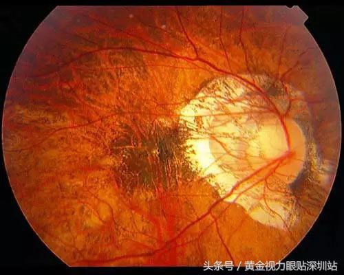 黄斑病变是眼癌吗,致眼盲疾病有哪些
