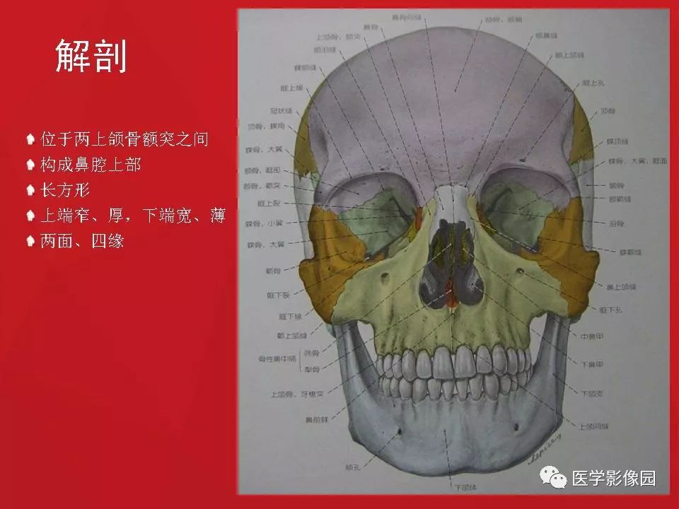 左侧鼻骨骨折伴鼻中隔骨折,双侧鼻骨及左上颌骨突骨折