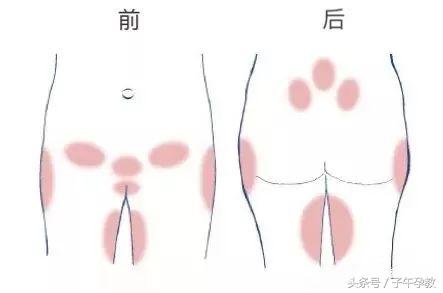 孕期坐久了尾骨痛怎么缓解,怀孕前期久坐屁股尾骨痛怎么回事