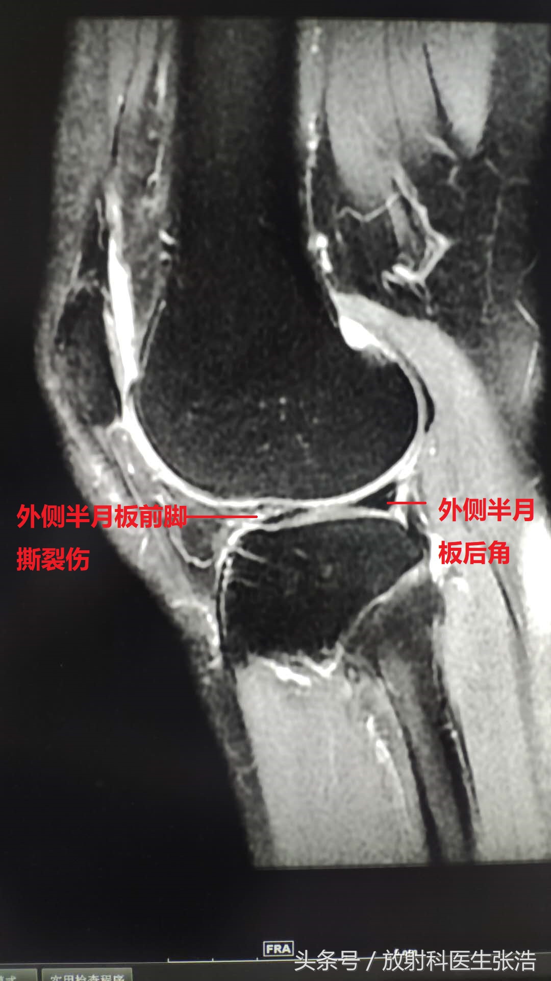 膝关节疼照x光片有用吗,膝关节疼痛x光片能看出来吗