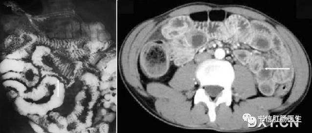 10种经典肠道影像征象：绳征、串珠征、螺纹征……你听过几个？