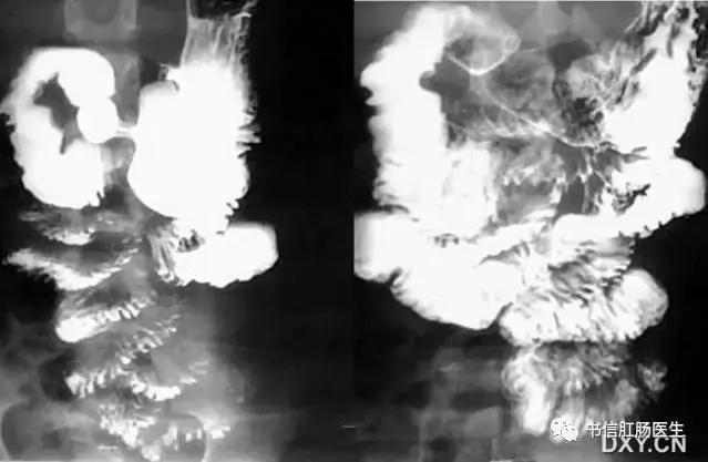 10种经典肠道影像征象详解