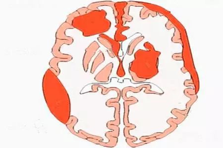 急性脑出血昏迷黄金抢救时间,脑出血病人急救黄金30秒