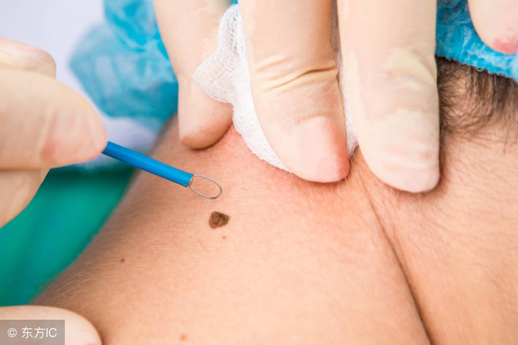 点痣的危害与副作用为什么会长痣,点痣有哪些注意事项