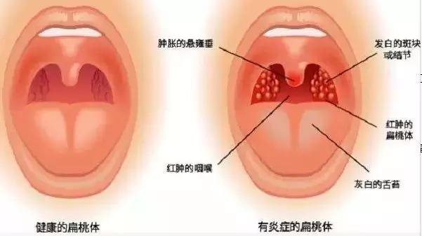 小孩反复扁桃体发炎发烧要切除吗,小孩经常扁桃体发炎发烧能切除吗