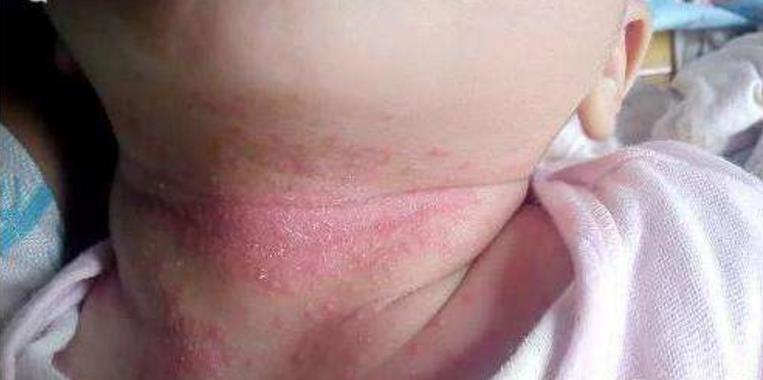 宝宝起了痱子怎么办?90%的家长都做错了
