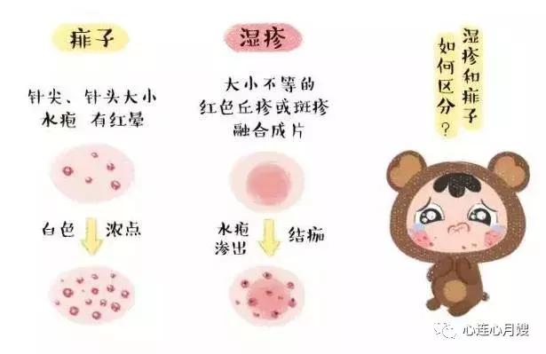 痱子和湿疹怎么区别,痱子和湿疹摸起来有什么区别