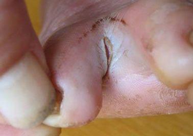 治疗足癣烂脚丫用什么药 (手癣足癣药物)