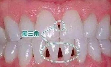 牙齿上的黑三角是怎么形成的,牙齿上的黑三角怎么治疗