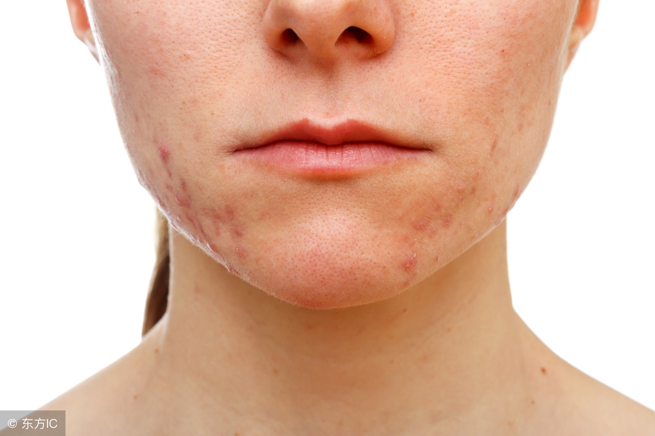 和痘印拜拜30天,跟青春痘说拜拜