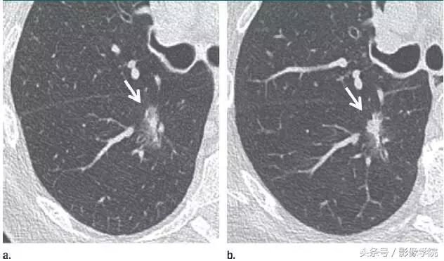 肺结节14种影像,一百例有结果的肺结节影像分析