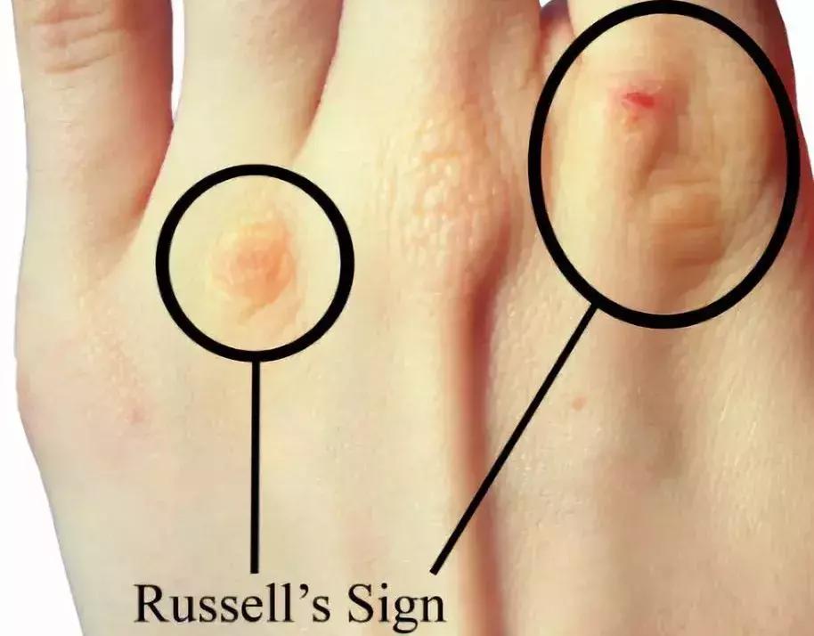 催吐,外挂般的减肥方式?吃的是欲望,吐的是灵魂