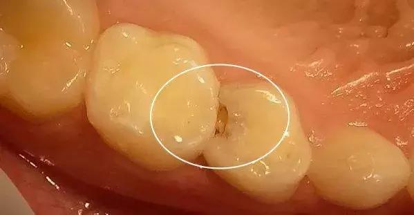 原来蛀牙是这样修复,牙齿开始蛀牙怎样防止恶化