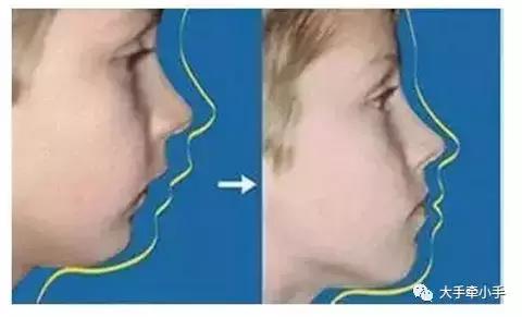 牙齿不齐矫正好还是做牙冠好,牙齿不齐矫正1个月的变化