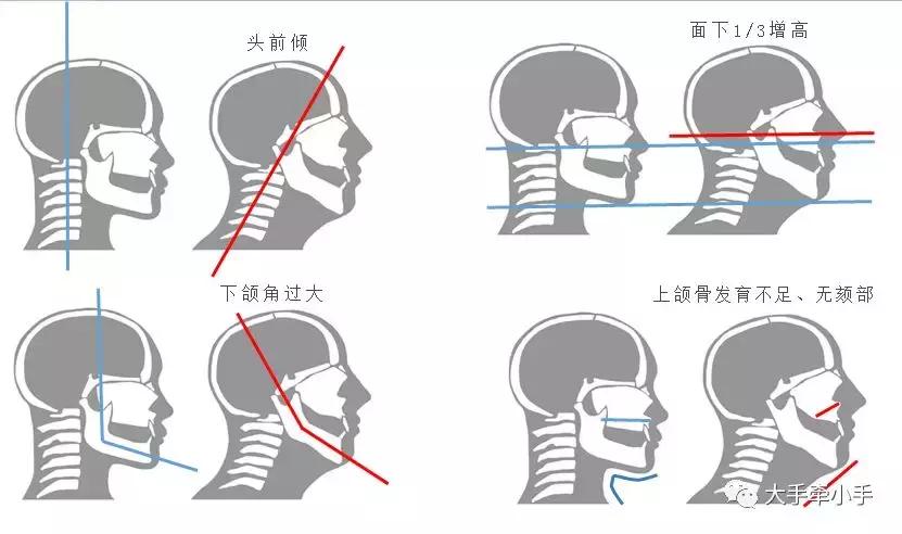 牙齿不齐矫正好还是做牙冠好,牙齿不齐矫正1个月的变化