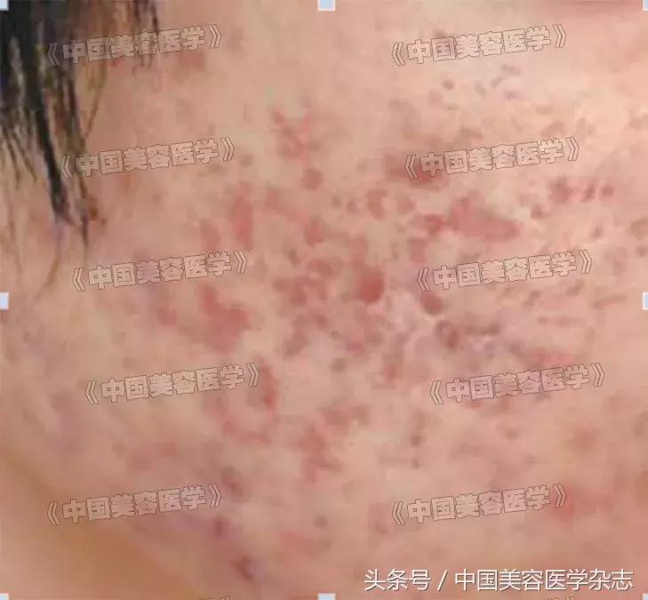 点阵激光打凹陷性疤痕,点阵激光治疗瘢痕疙瘩的效果